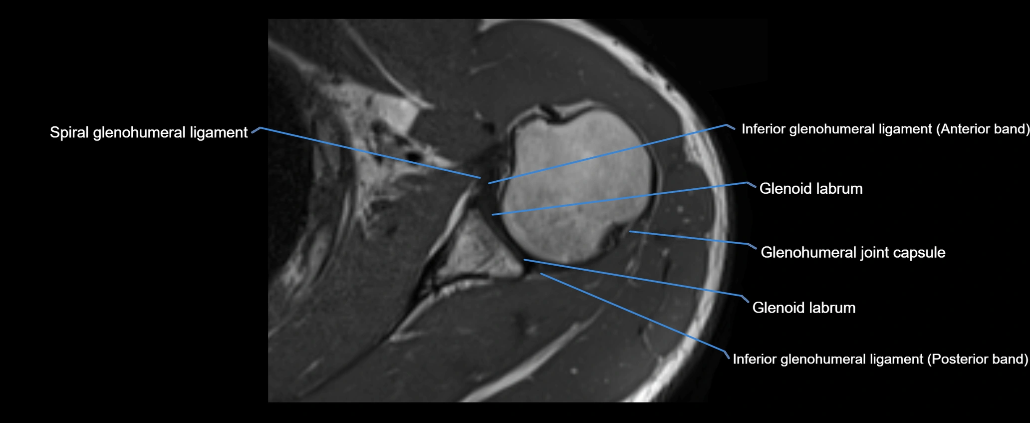 shoulder ligaments axial 3d 3t mri image-img-00005-00074.webp